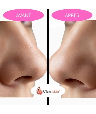 Aspirateur à Points Noirs Professionnel  – SKIN-VAC™